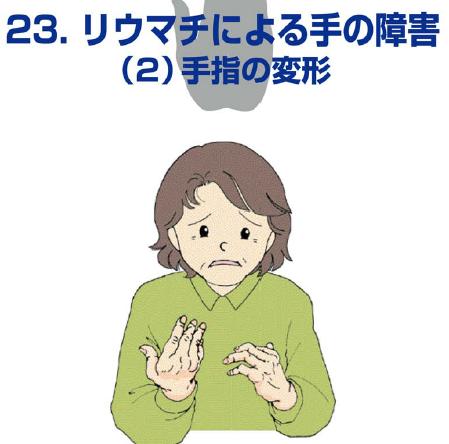 リウマチによる手の障害（2）手指の変形