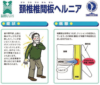 頸椎椎間板ヘルニア